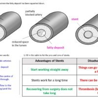 Cardiovascular Disease Label WS Labelled illustration of a stent and how they are used